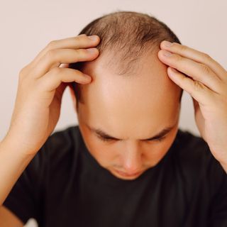 Cura per la calvizie avanzata: trattata efficacemente con un approccio multidisciplinare