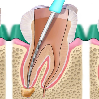 Cos’è l’Endodonzia?