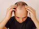Cura per la calvizie avanzata: trattata efficacemente con un approccio multidisciplinare