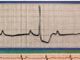 Alba: elettrocardiogrammi gratuiti per tutti grazie alla Croce Rossa Alba: elettrocardiogrammi gratuiti per tutti grazie alla Croce Rossa