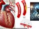 Quando fare l’angioplastica coronarica? Ora lo dice l’Intelligenza Artificiale
