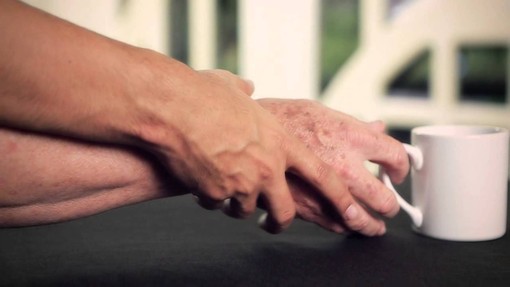 BRAdiParki aps presenta le sue attività per affrontare il Parkinson BRAdiParki aps presenta le sue attività per affrontare il Parkinson