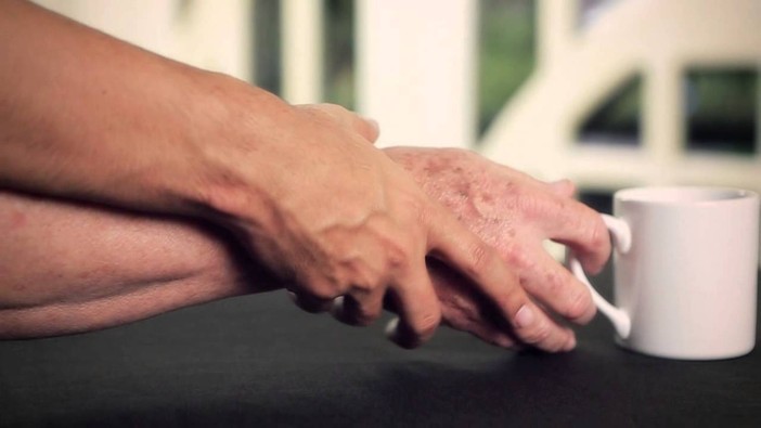 BRAdiParki aps presenta le sue attività per affrontare il Parkinson