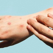 Vaiolo delle scimmie, per la Regione gay, trans e bisex a maggior rischio infezione. Ma si trattava di una circolare del 2022 Vaiolo delle scimmie, per la Regione gay, trans e bisex a maggior rischio infezione. Ma si trattava di una circolare del 2022