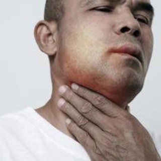 Angioedema ereditario, Aifa estende uso lanadelumab dai 2 anni di età