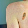 Melanoma, la firma mutazionale del cancro potrà cambiare la cura Melanoma, la firma mutazionale del cancro potrà cambiare la cura