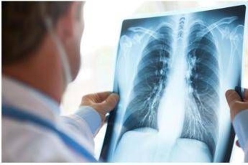 Tumore al polmone a piccole cellule in stadio esteso, ok Aifa a primo anti Pd-1 in prima linea