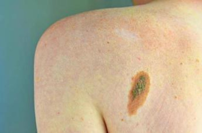 Melanoma, Adoi: "Bene nuova legge su prevenzione, dermatologo centrale in screening" Melanoma, Adoi: "Bene nuova legge su prevenzione, dermatologo centrale in screening"