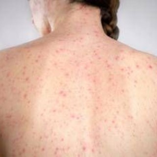 Morbillo, dagli aeroporti Usa alle scuole di Londra: dilagano gli alert